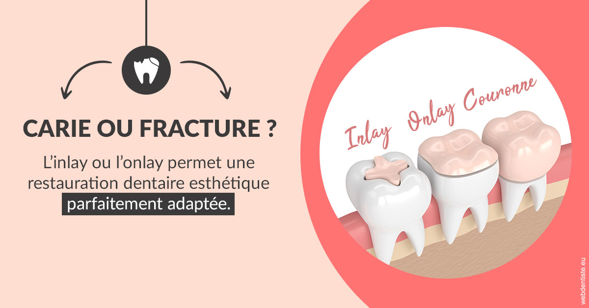 https://dr-levy-charles.chirurgiens-dentistes.fr/T2 2023 - Carie ou fracture 2
