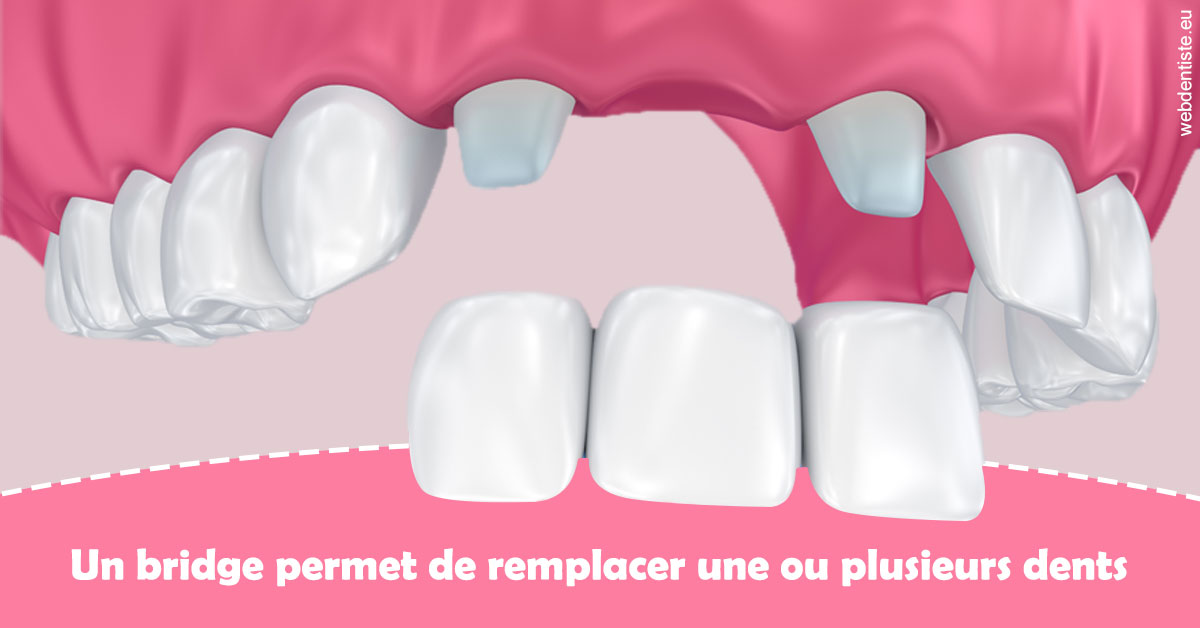 https://dr-levy-charles.chirurgiens-dentistes.fr/Bridge remplacer dents 2