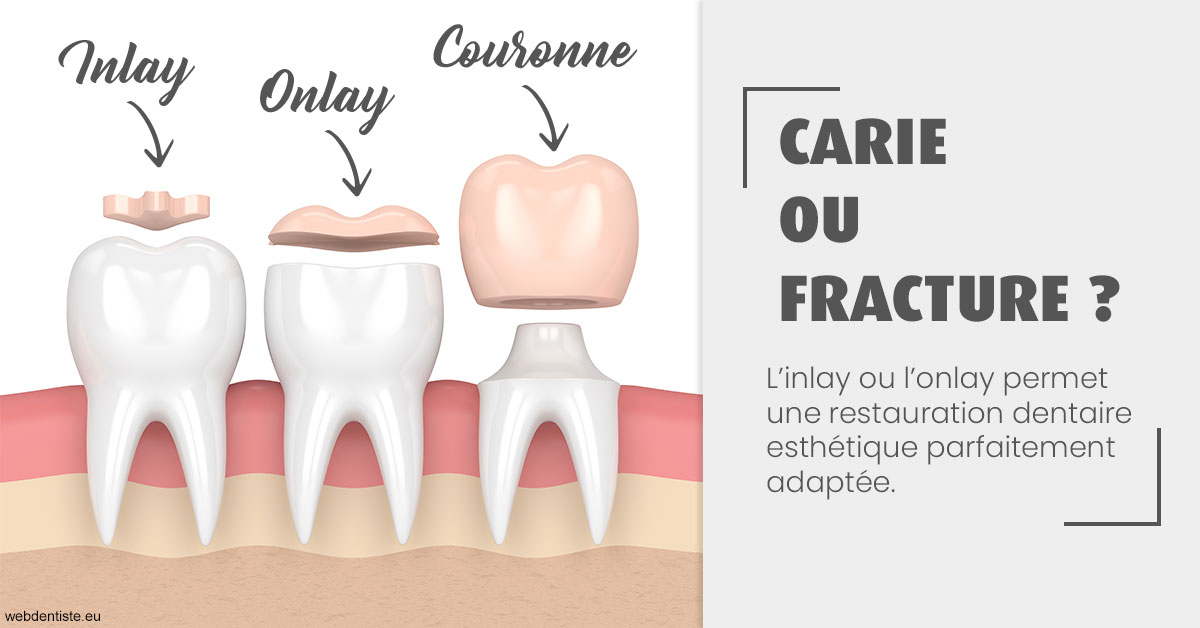 https://dr-levy-charles.chirurgiens-dentistes.fr/T2 2023 - Carie ou fracture 1