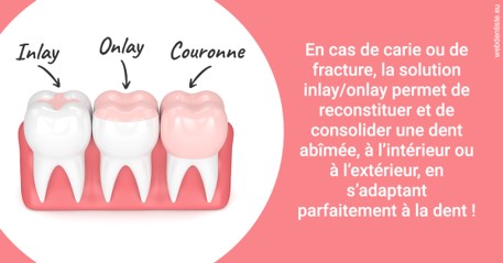 https://dr-levy-charles.chirurgiens-dentistes.fr/L'INLAY ou l'ONLAY 2