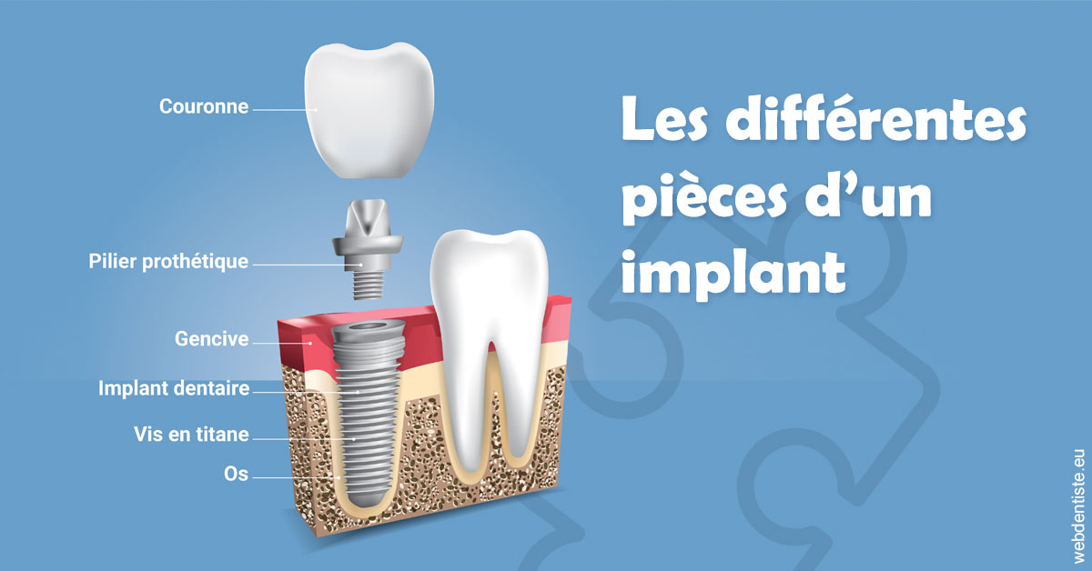 https://dr-levy-charles.chirurgiens-dentistes.fr/Les différentes pièces d’un implant 1